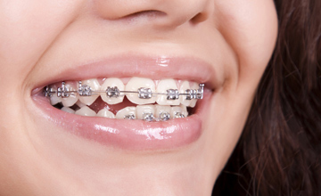 orthodontics braces-1